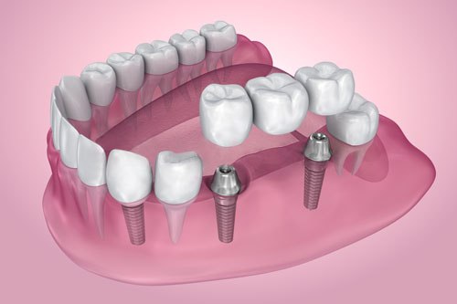 Implantología Dental